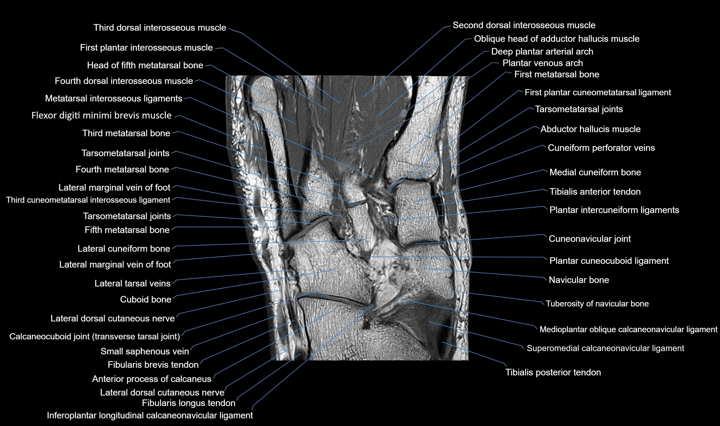 MRI mid foot coronal ligaments cross sectional anatomy 3T  radiology  image-img-00001-00024.webp